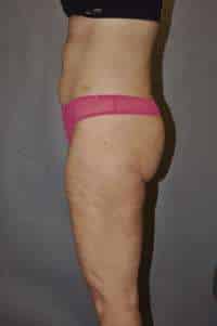 Liposuction