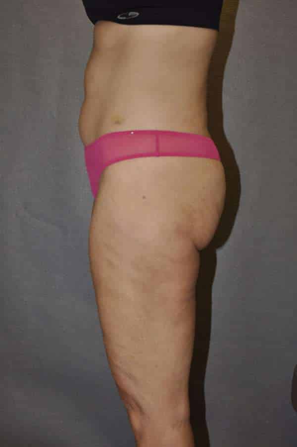 Liposuction