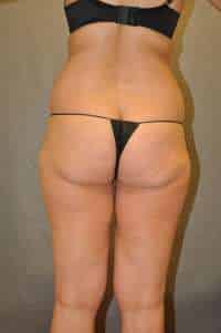 Liposuction