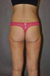 Liposuction