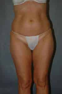 Liposuction