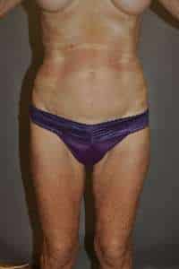 Liposuction
