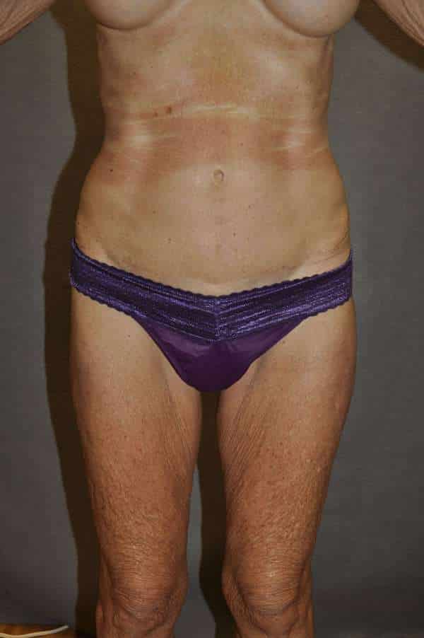 Liposuction