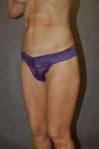 Liposuction