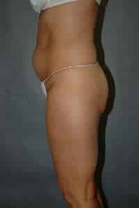 Liposuction