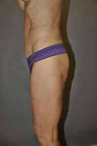 Liposuction
