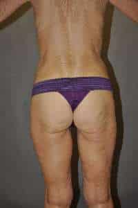 Liposuction