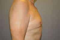 Nipple Reduction