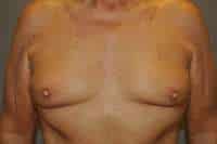 Nipple Reduction