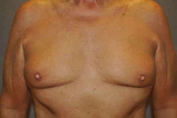 Nipple reduction for men before photo