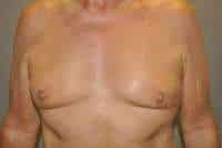 Nipple Reduction