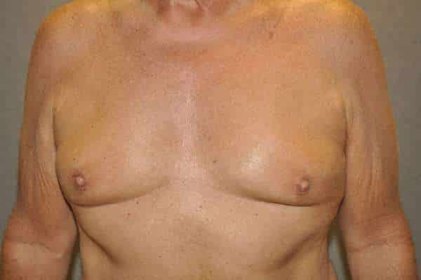 Nipple reduction for men after photo