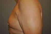 Nipple Reduction