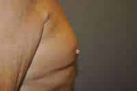 Nipple Reduction