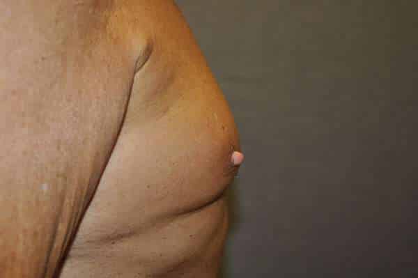 Nipple Reduction