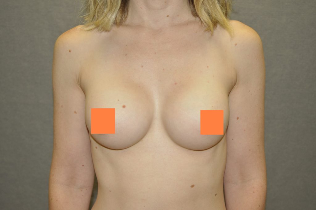 Breast Augmentation