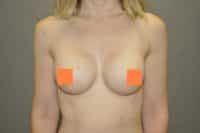 Breast Augmentation