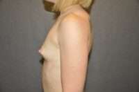 Breast Augmentation