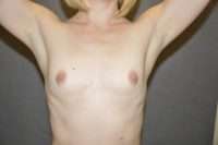 Breast Augmentation