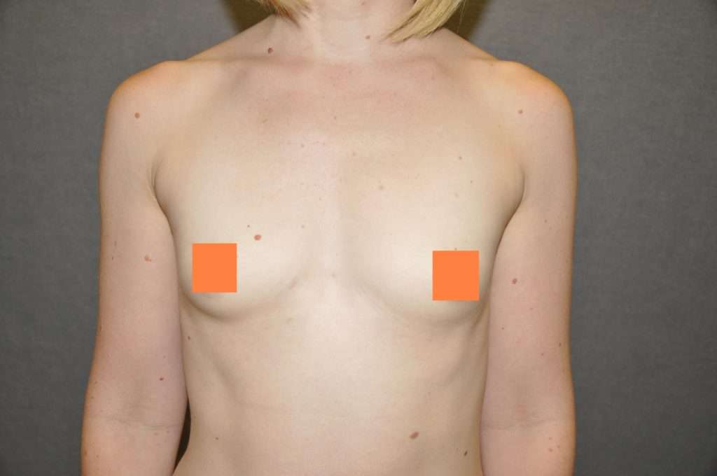 Breast Augmentation