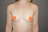 Breast Augmentation
