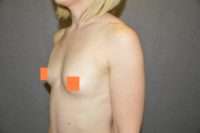 Breast Augmentation