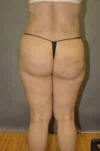 Brazilian Butt Lift