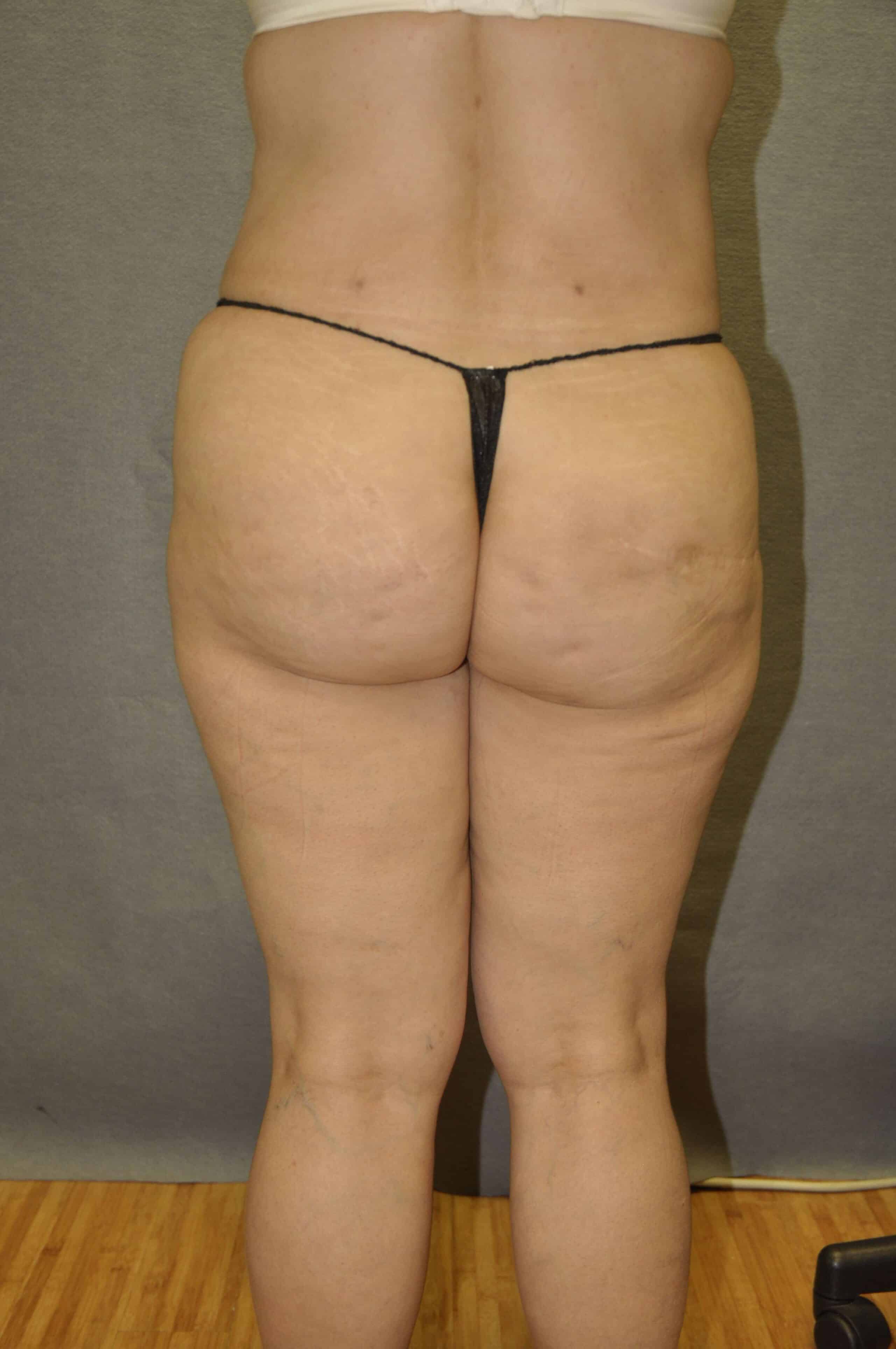 BRAZILIAN BUTT LIFT Before and After Results