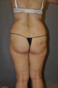 Brazilian Butt Lift
