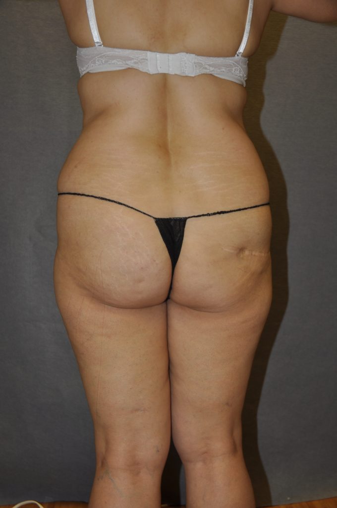 Brazilian Butt Lift