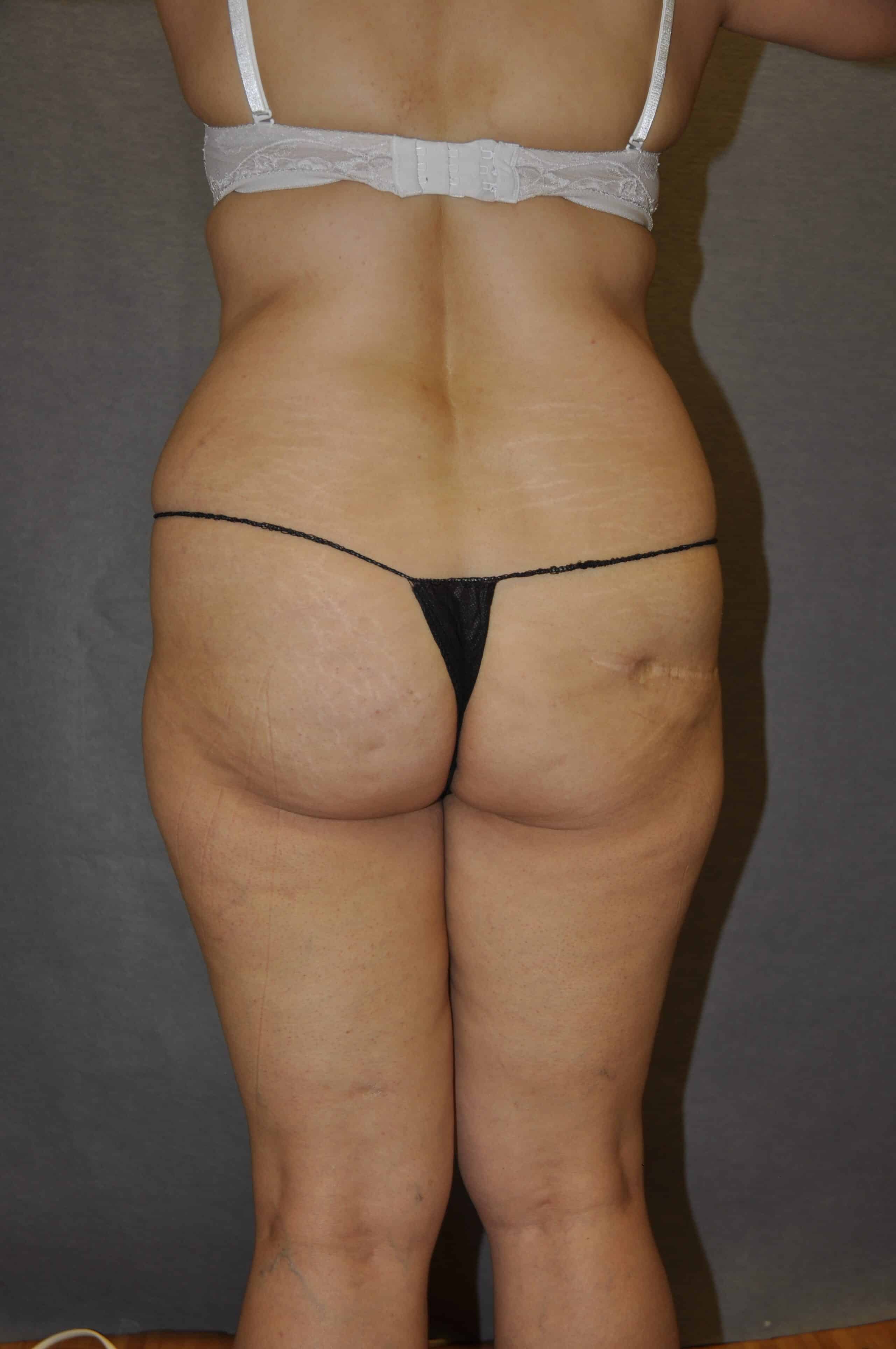 BRAZILIAN BUTT LIFT Before and After Results