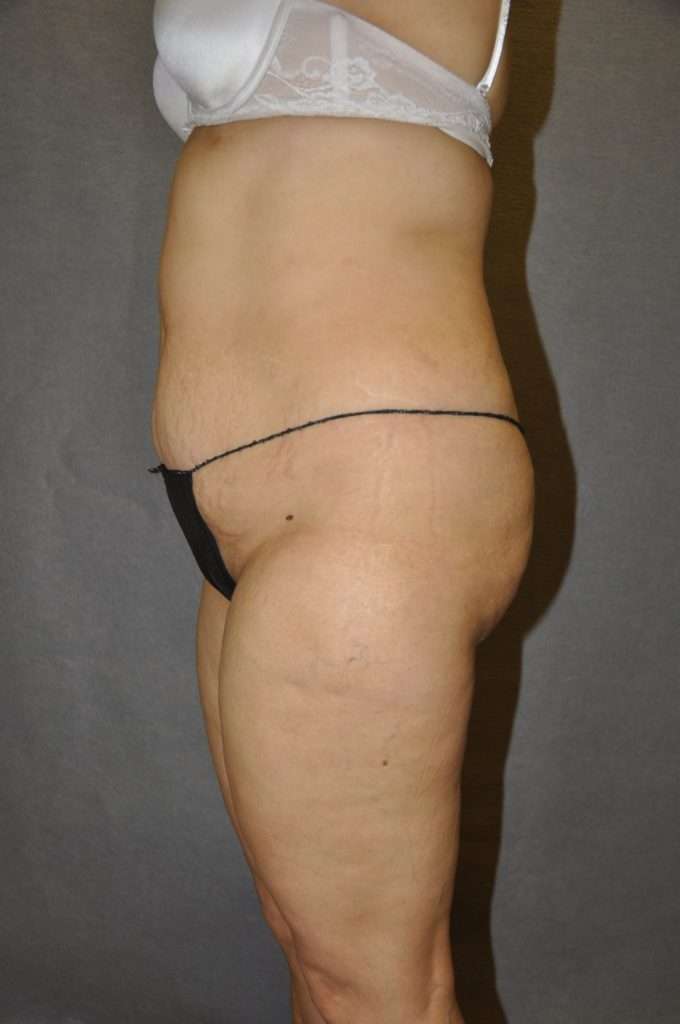 Brazilian Butt Lift