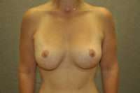 Breast Lift