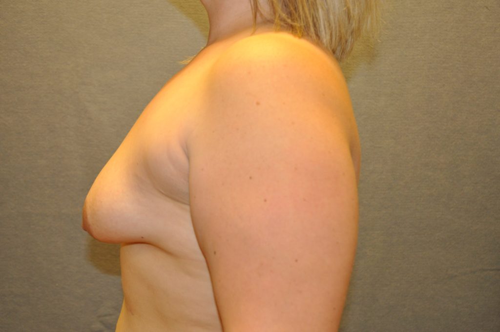 Breast Lift
