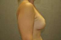 Breast Lift