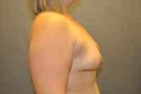 Breast Lift