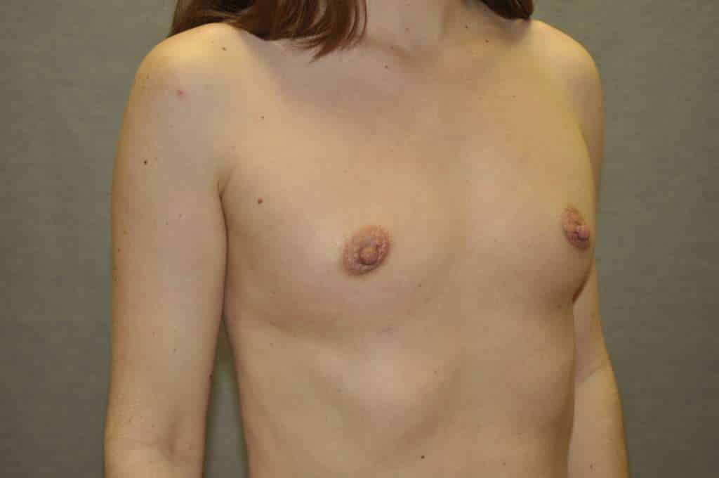 Fat Transfer