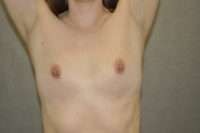 Fat Transfer