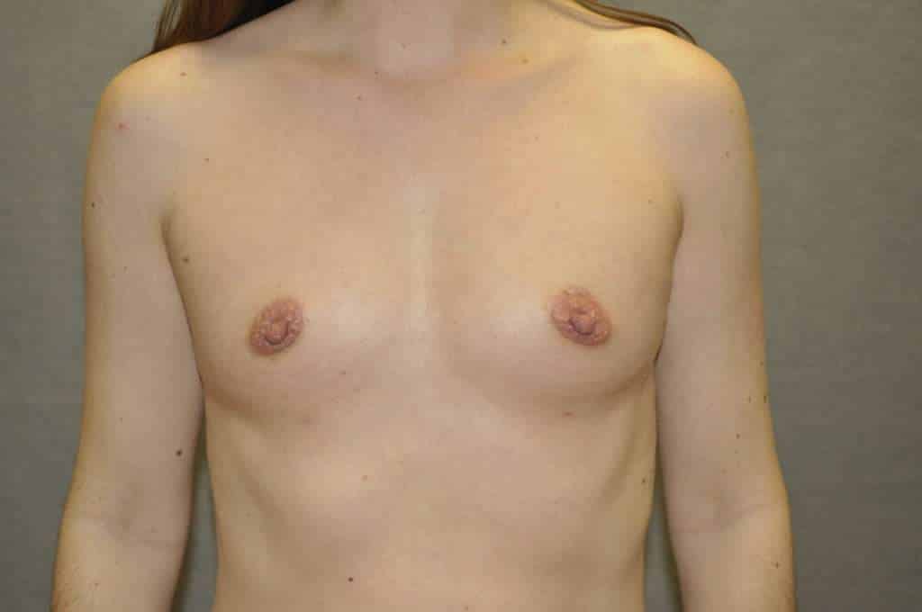 Fat Transfer