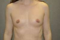 Fat Transfer