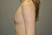 Fat Transfer
