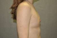 Fat Transfer