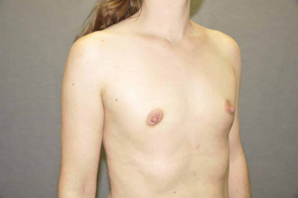 Fat Transfer