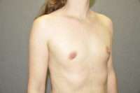 Fat Transfer