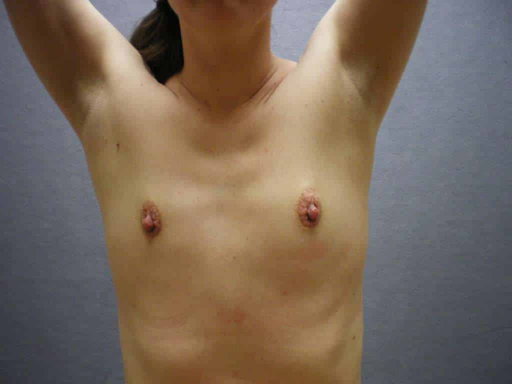Fat Transfer