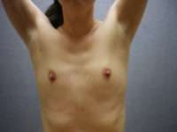 Fat Transfer
