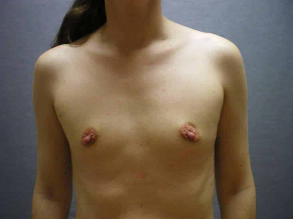 Fat Transfer