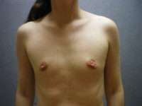 Fat Transfer
