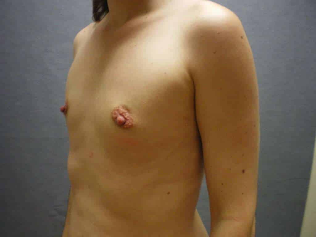 Fat Transfer