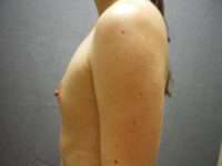 Fat Transfer